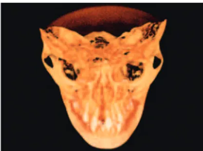 FIGURE 5 - The 3D cone beam CT image reveals no fracture or crack line  after 7 weeks of Alt-RAMEC in the circumaxillary facial bones of a girl.