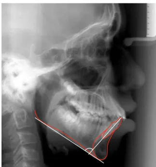 FIGURE 2 - Lower incisor inclination measurement.