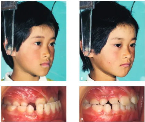 FIGURA 2 - Análise da face e da oclusão após dois anos. A mordida cruzada anterior foi corrigida na irmã B, por meio do uso da mentoneira