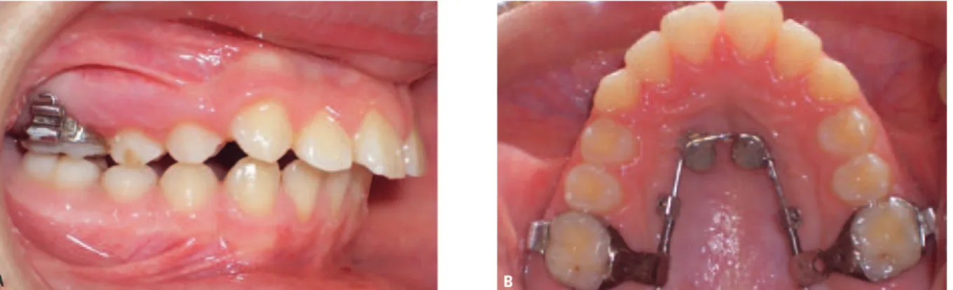 FIGURA 7 - Vistas lateral ( A ) e oclusal ( B ) do MISDS (Miniscrew Implant Supported Distalization System).
