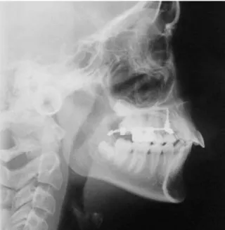FIGURA 8 - Telerradiografia evidenciando que a força de distalização do  MISDS passa pelo centro de resistência dos molares.