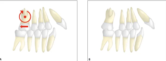 FIGURA 3 - Na tração extrabucal cervical ( A ) e nos dispositivos intrabucais de distalização ( B ) a força passa abaixo do CR, inclinando e extruindo os pri- pri-meiros molares superiores.