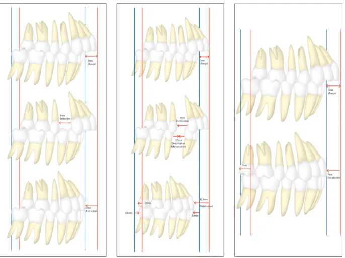 FIGURE  3  -  Diagram  showing  the  amount  of  movement required to correct a complete Class  II malocclusion (7 mm overjet) treated with the  extraction of two upper premolars.