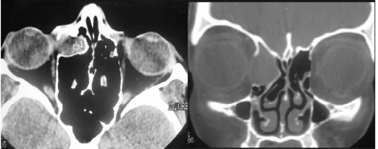 Figure 1. Nasal fossa and paranasal sinuses CT scan at axial and coronal sections evidencing right frontoethmoidal region.