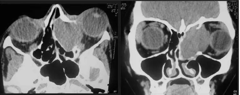 Figure 2. Nasal fossa and paranasal sinuses CT scan at axial and coronal sections evidencing image of left frontoethmoidal region with displacement of ocular globe on the left (proptosis).