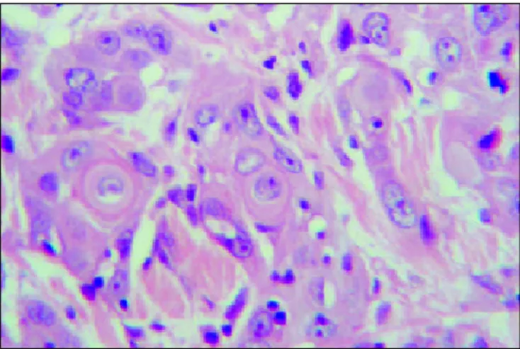 Figure 2.  Moderately differentiated squamous cell carcinoma (HE, 400X) with evidence of keratin cells.