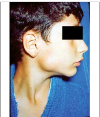 Figure 1. Parotid region bowing.