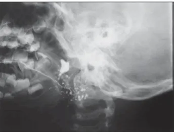 Figure 3. RRL Sialography (case 4) with sacculus dilations in distal ramifications of left Stenon duct, compatible with chronic sialodenitis.