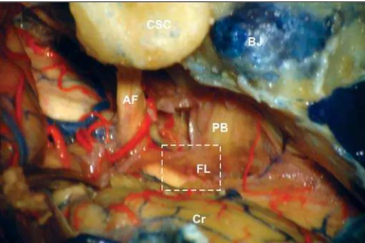 Figure 1. The lateral limits were semicircular canals (SCS) and jugular bulb (BJ), Cranial nerves 7th and 8th (AF), related with the otic capsule, and cranial nerves 9th, 10th and 11th (PB), related to jugular bulb, can be seen from their emergence in the 