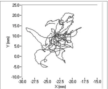 Figure 5. Stabilometric tracing of patient A.M.V with closed eyes.