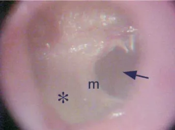 Figure 2. Otomicroscopy showing marked diffuse opacification of the tympanic membrane