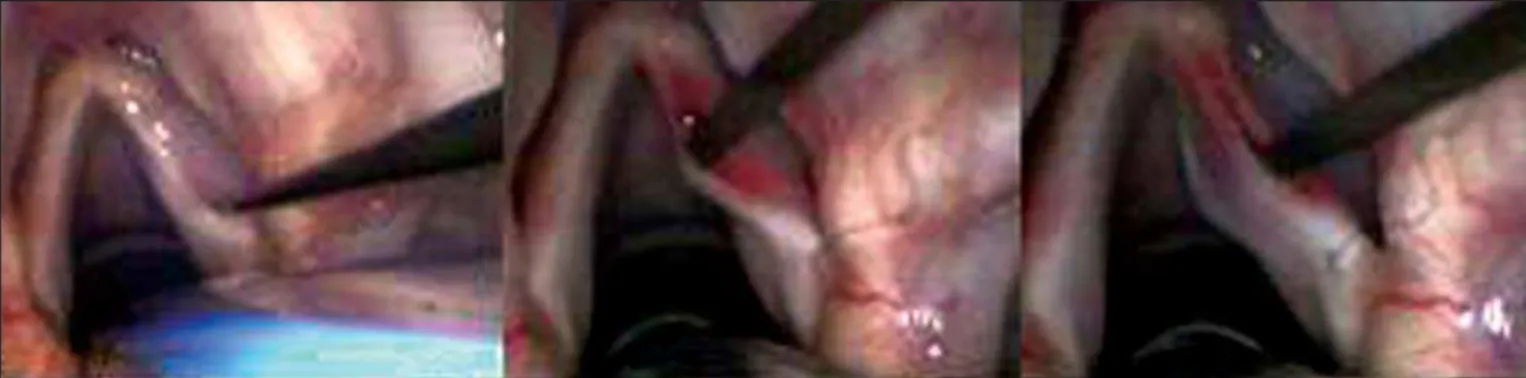 Figure 1. Incision made on the upper surface of the vocal fold and subepithelial detachment.