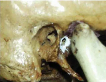 Figure 1. Foramen of Huschke evidenced with barium sulfate.
