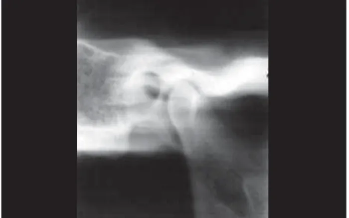 Figure 3A. Corrected lateral CTs can - TMJ CT scan sections - section A without contrast material.