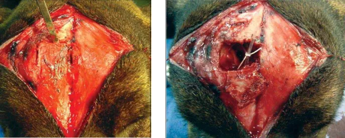 Figure 6. Sinus opening and flap elevation Figure 7. Osteoplastic flap fixed to the periosteum; insertion of catheter into the nasofrontal duct.
