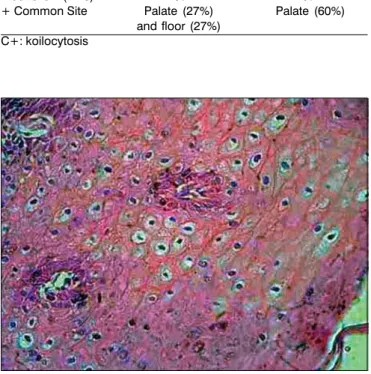 Figure 1. Hematoxylin-eosin stained slides showing koilocytosis: cells with picnotic halo, surrounded by clear outside halos with volume generally higher than that of the cytoplasm.