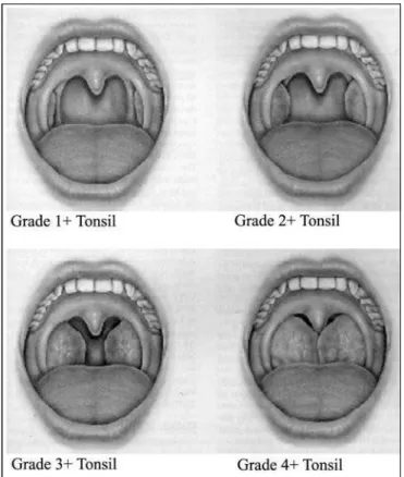 Figure 1 – Grading of palatine tonsils hypertrophy proposed by L.