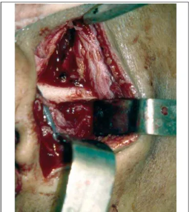 Figure 1. Demarcation of osteotomy in the articular eminence with 702 drill.