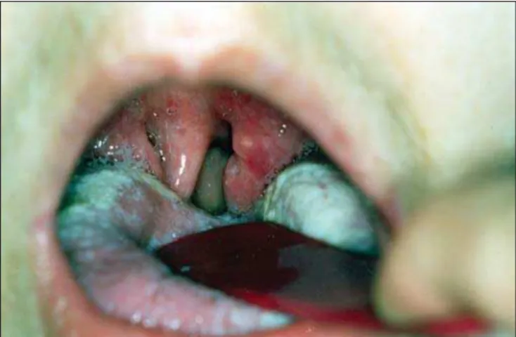 Figure 1. Oropharyngoscopy showing erythematous aspect of palatine tonsils, uvula edema and tongue monolyasis.