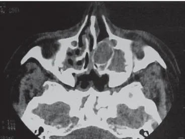 Figure 2. Paranasal sinuses CT scan (coronal section) showing mucopyocele located in the left middle concha.