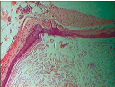 Figure 1. Epidermoid cyst – Innermost corneal layer (lower figure) followed by granulated, squamous and basal layers.