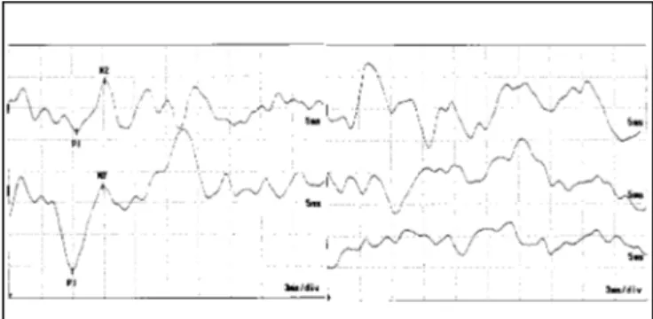 Figure 3. Waves P1 and N2 latency at VEMP in case 1 of the EM group. Absence of response on the right