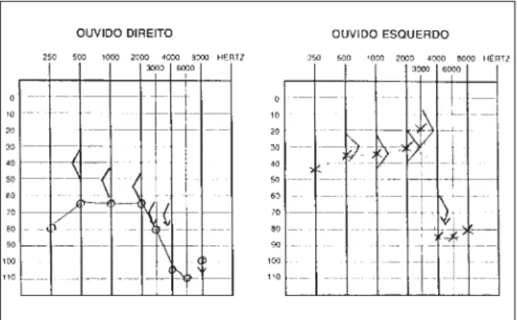 Figure 1. Audiometry with sensorineural hearing loss on the left and mixed loss on the right.