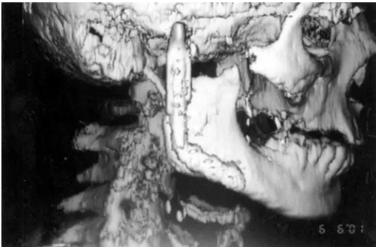 Figure 7.  3D C/T view, ten months postoperatively