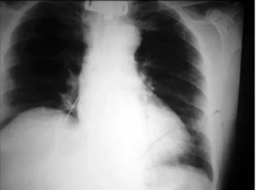 Figure 1. Chest X-ray in PA showing foreign body in right source bronchus.
