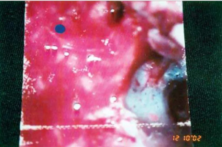 Figure 2. Transoperative picture of modified radical mastoidectomy showing intact TM and CEAC affecting the mastoid.
