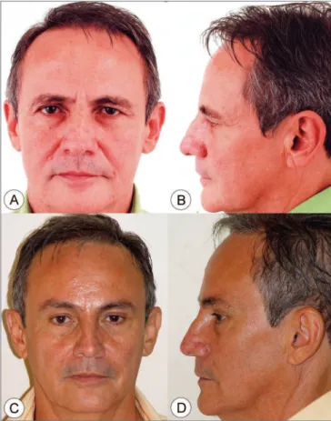 Figure 5. Frontal view (A) and side view (B) of a 45 year old female  patient  with  enlarged  nasolabial  groove,  moderate  drop  of  malar  prominence and moderate jaw line ptosis