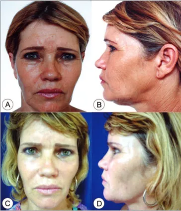Figure 6. Frontal view (A) and side view (B) of a 51 year old female  patient with moderately enlarged nasolabial groove, moderate drop  of malar prominence and moderate jaw line ptosis