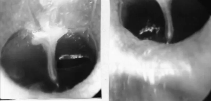 Figure 2b. Triangular tympanocentesis by microknife (left), and oval  by argon laser (right).
