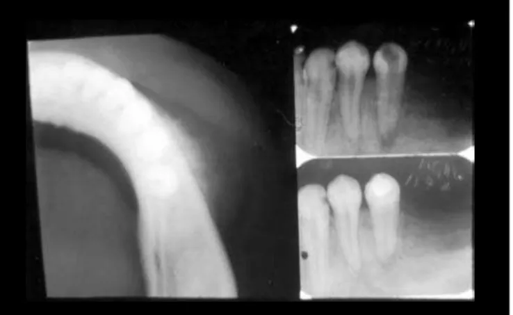 Figure 1. Occlusal radiographic view showing the external cortical portion with radiopacity similar to “sunrays” (on the left)