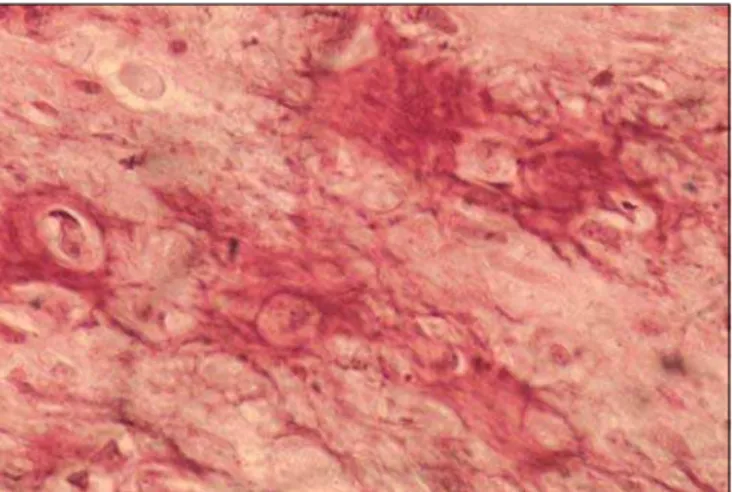 Figure 2. Photomicrography showing osteoid area and mild cellular pleomorphism (HE/400x).