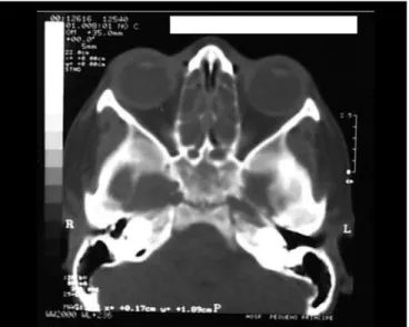 Figure 2. Coronal cross-section showing velamentum of maxillary sinuses and ethmoidal cells and bilateral obliteration of the infundibulum.