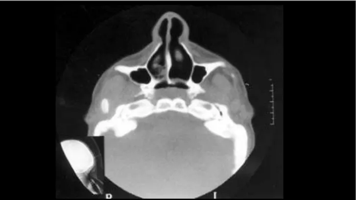 Figure 5.  Results post-advanced mentoplasty.