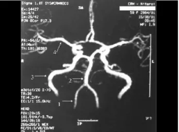 Figure 1. Normal anatomy of arteries: 1 – vertebral; 2 – basilar; 3 – internal carotid; 4 – media cerebral artery.