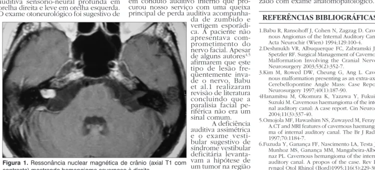 Figura 1. Ressonância nuclear magnética de crânio (axial T1 com  contraste) mostrando hemangioma cavernoso à direita.