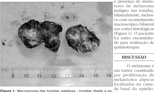 Figura 1. Macroscopia das tonsilas palatinas - tonsilas direita e es- es-querda com áreas de hipercromia.