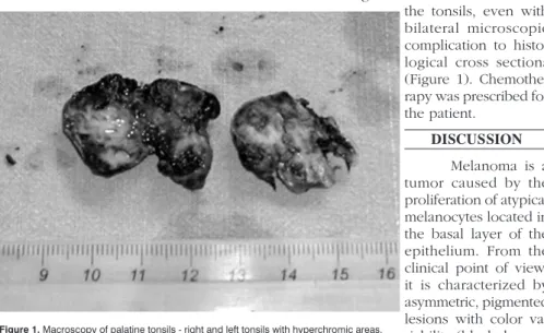 Figure 1. Macroscopy of palatine tonsils - right and left tonsils with hyperchromic areas.