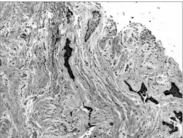 Figure 1. Connective stroma densely collagenized and permeated by  compressed epithelial neoplastic islets, as well as by epithelial islet with  peripheral cells arranged in palisade (H/E, 40x).