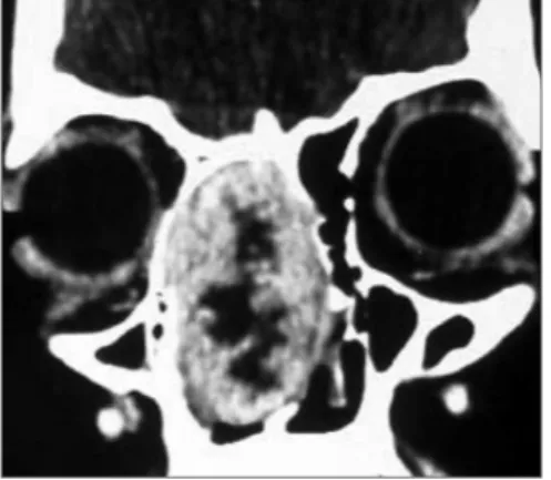Figure 1. Coronal CT scan image showing a tumor in the right  nasal cavity, with intact intracranial and orbital limits