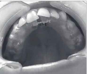 Figure 1. Mouth piece used for maxillary expansion.