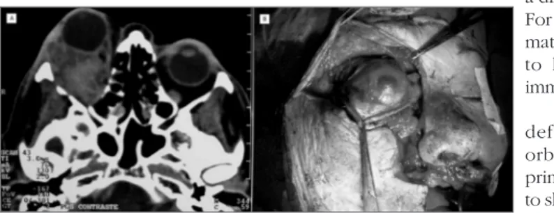 Figure 1. Photography showing an orbit primary melanoma in a CT Scan axial view (A) and  during exenteration of the right orbit via broadened Weber-Fergusson incision towards the  eyebrow region (B).