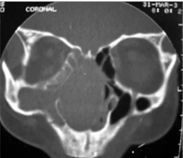 Figure 1. Computed tomography of the paranasal sinuses - coronal  plane. Soft tissue attenuation material occupies the nasal fossae, the  right maxillary sinus, and some ethmoid cells