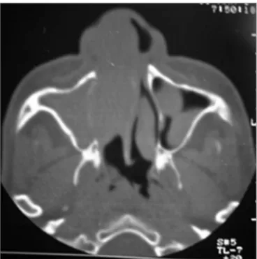 Figure 3. Microscopy exam of the nasal mucosa showing a lympho- lympho-plasmacytic infiltrate with Mikulicz cells, Russel bodies and congested  and dilated blood vessels.