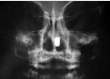 Figure 2. Nasal cavities foreign bodies (clockwise starting on the left upper corner): button, toy piece, pen lid, coin.