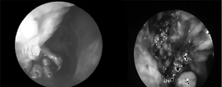 Figure 3. Nasal cavities myiasis.