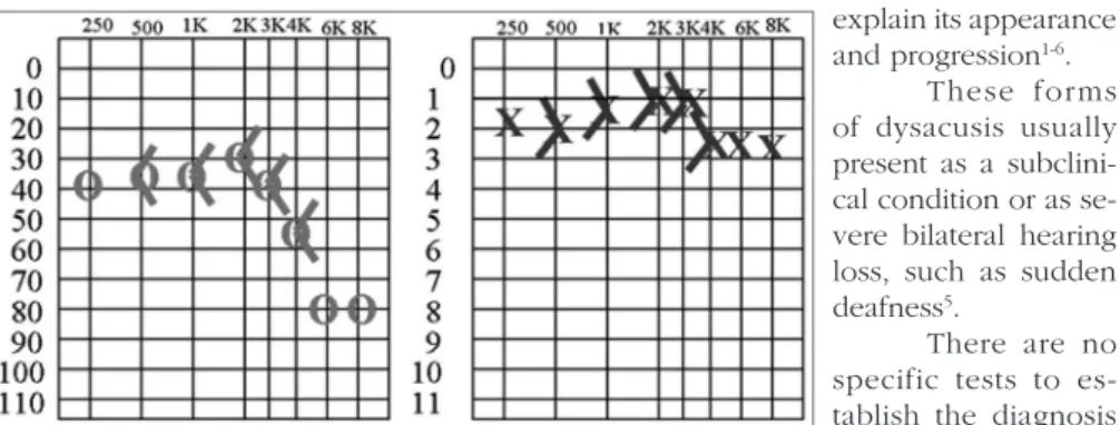 Figure 1. Pure tone and vocal audiometry during recurrence of the condition.